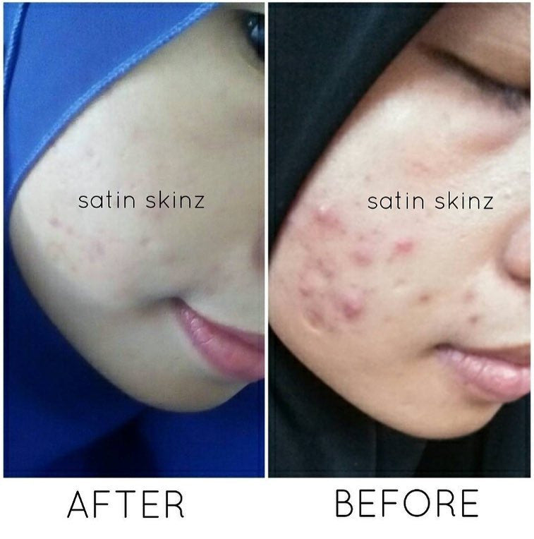 Satin Skinz premium helps you with your breakouts!