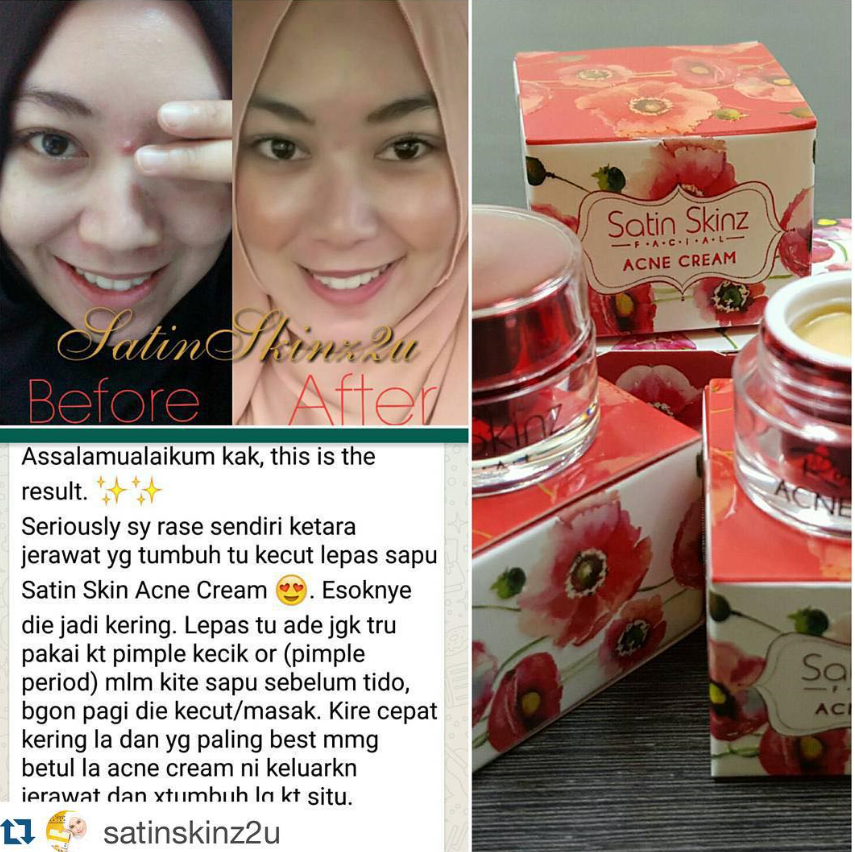 SatinSkinzacnecream has four actions