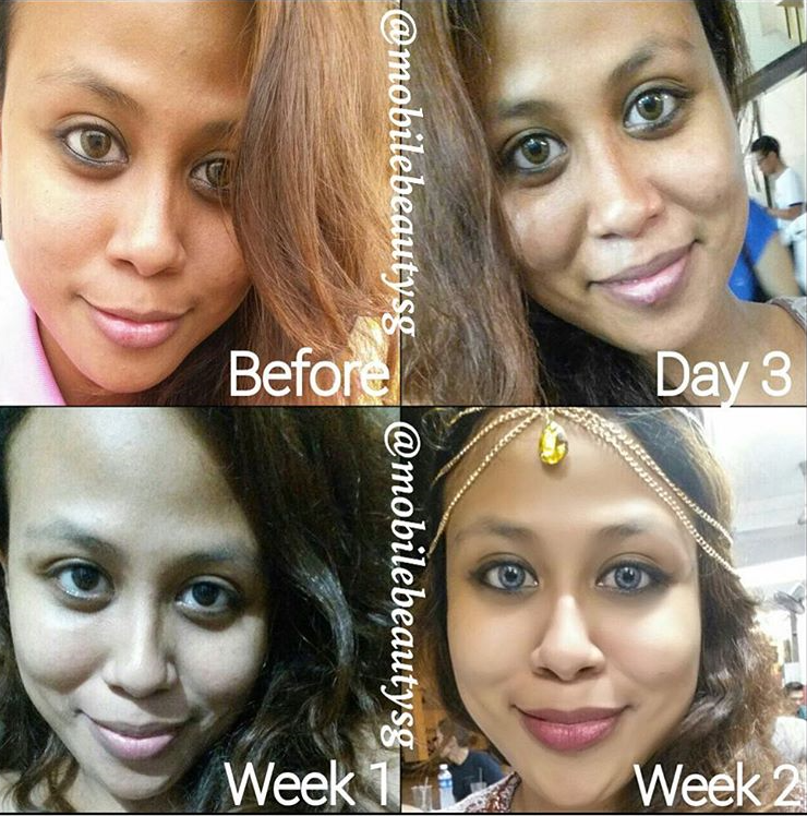 Only two weeks of Satin skinz premium her skin tone has completely evened out!